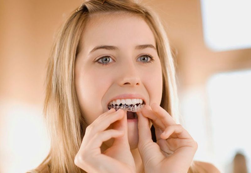 30 tuổi có nên niềng răng hay không? Giải đáp từ chuyên gia - Nha khoa Đại Nam