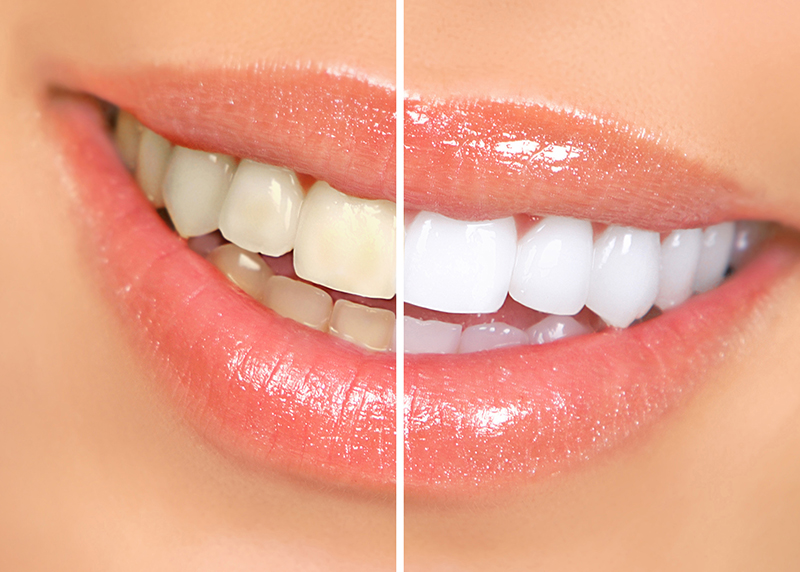 4 cách làm trắng răng tại nhà đơn giản mà không tốn tiền | Medlatec
